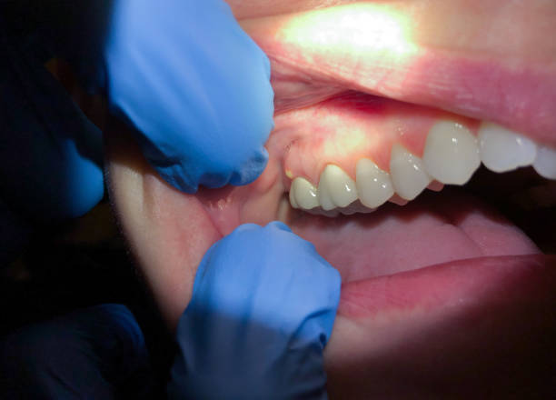 Best Emergency Tooth Extraction in Port Edwards, WI